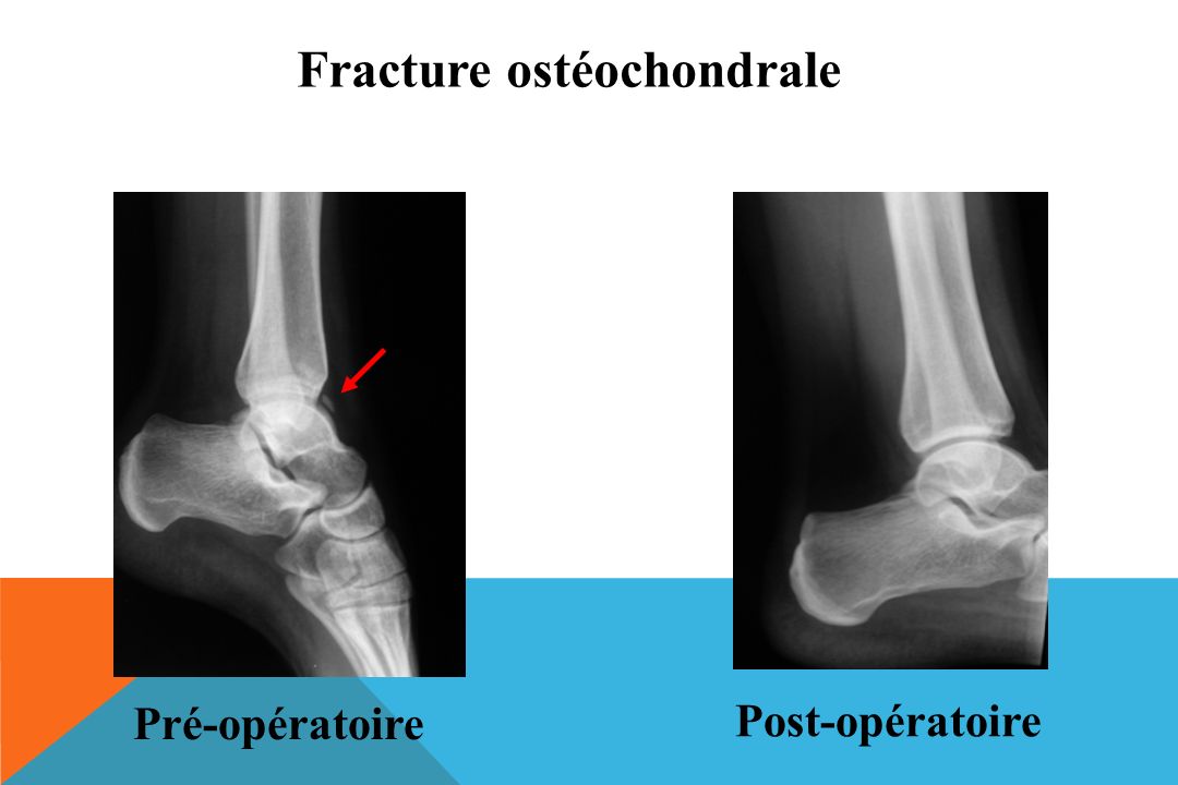 Notre exp rience de l arthroscopie de cheville ppt video online